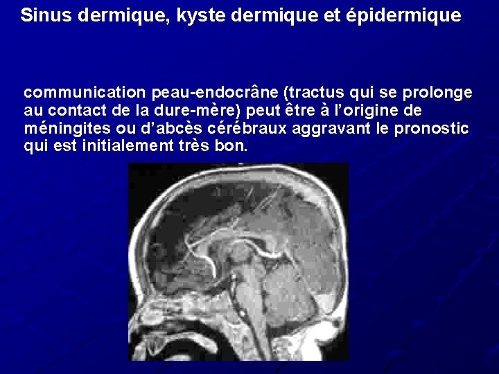 Sinus dermique, kyste dermique et épidermique communication peau-endocrâne (tractus qui se prolonge au contact