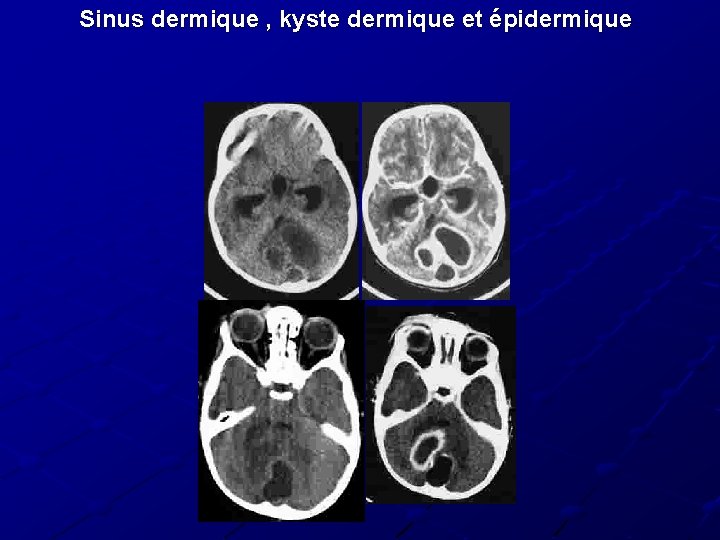 Sinus dermique , kyste dermique et épidermique Sinus dermique , kyste dermique et épidermique