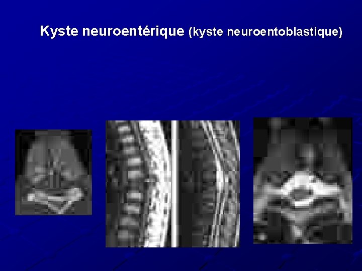Kyste neuroentérique (kyste neuroentoblastique) 