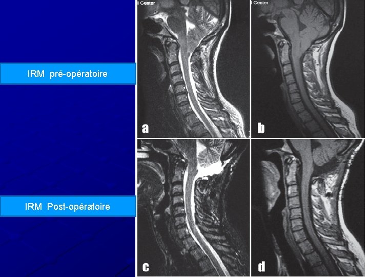IRM pré-opératoire IRM Post-opératoire 