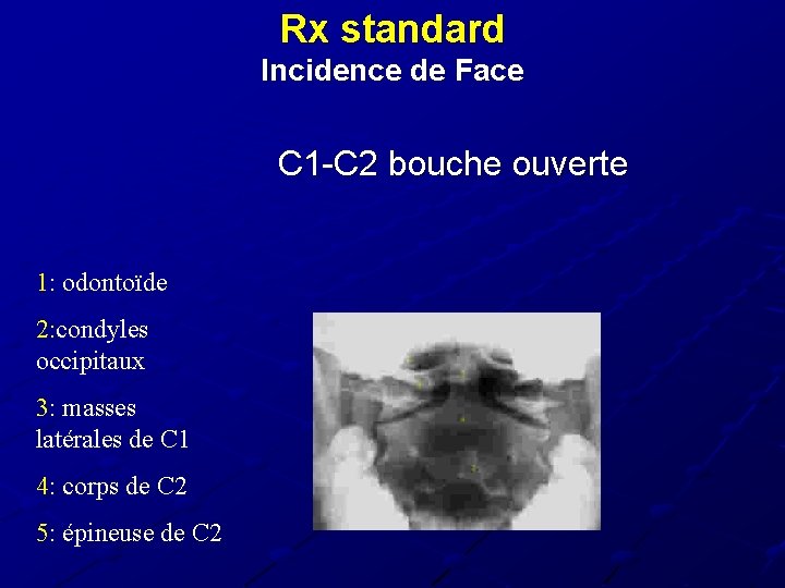 Rx standard Incidence de Face C 1 -C 2 bouche ouverte 1: odontoïde 2: Rx standard Incidence de Face C 1 -C 2 bouche ouverte 1: odontoïde 2: