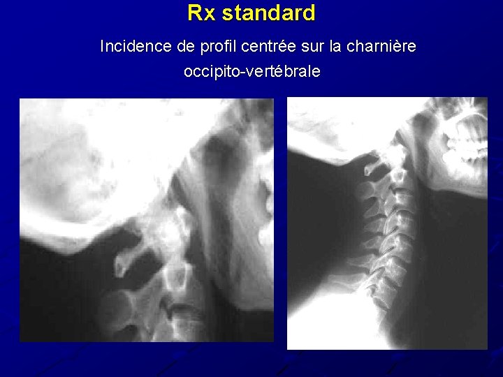 Rx standard Incidence de profil centrée sur la charnière occipito-vertébrale Rx standard Incidence de profil centrée sur la charnière occipito-vertébrale