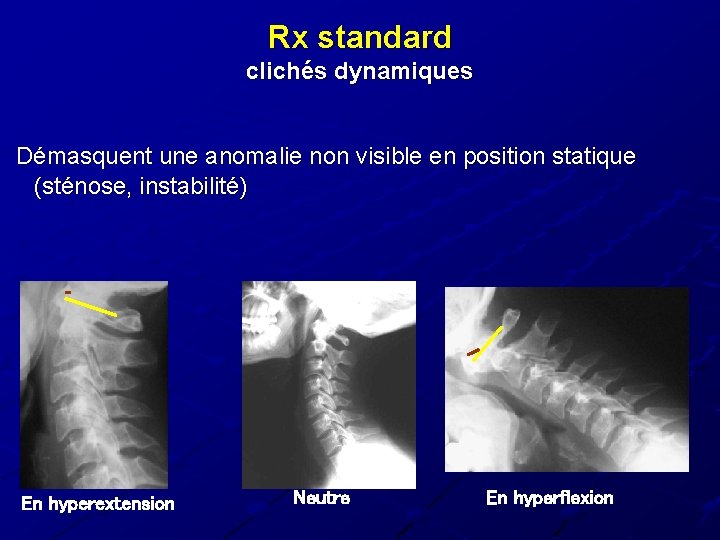 Rx standard clichés dynamiques Démasquent une anomalie non visible en position statique (sténose, instabilité) Rx standard clichés dynamiques Démasquent une anomalie non visible en position statique (sténose, instabilité)