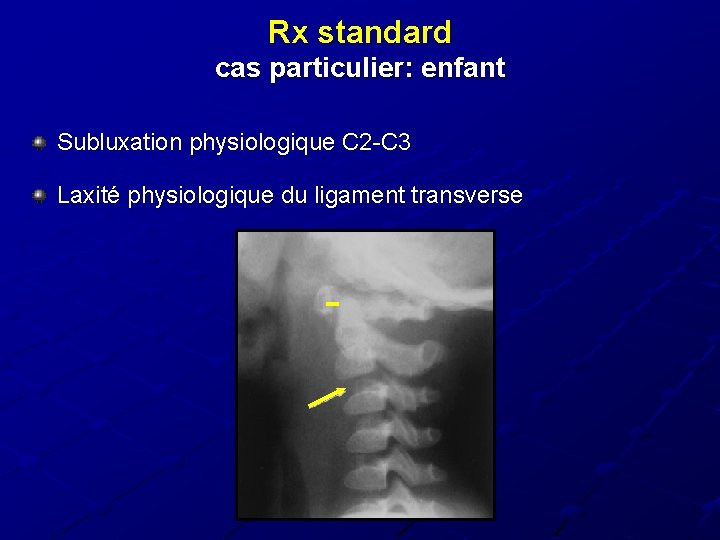 Rx standard cas particulier: enfant Subluxation physiologique C 2 -C 3 Laxité physiologique du