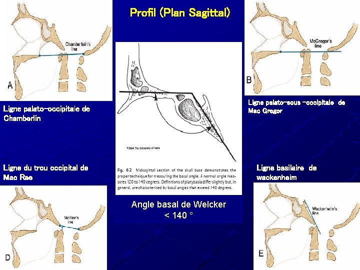 Profil (Plan Sagittal) Ligne palato-sous -occipitale de Mac Gregor Ligne palato-occipitale de Chamberlin Ligne