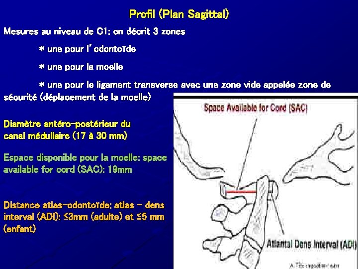 Profil (Plan Sagittal) Mesures au niveau de C 1: on décrit 3 zones *