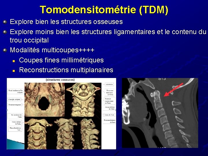 Tomodensitométrie (TDM) Explore bien les structures osseuses Explore moins bien les structures ligamentaires et Tomodensitométrie (TDM) Explore bien les structures osseuses Explore moins bien les structures ligamentaires et