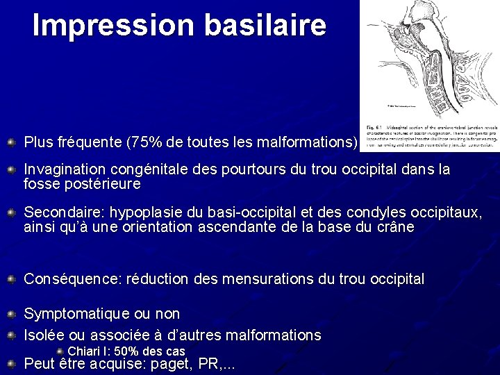 Impression basilaire Plus fréquente (75% de toutes les malformations) Invagination congénitale des pourtours du Impression basilaire Plus fréquente (75% de toutes les malformations) Invagination congénitale des pourtours du