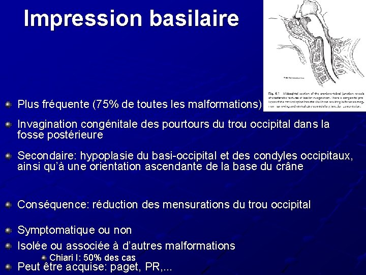 Impression basilaire Plus fréquente (75% de toutes les malformations) Invagination congénitale des pourtours du