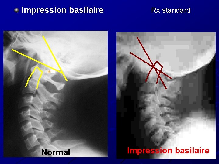 Impression basilaire Normal Rx standard Impression basilaire 