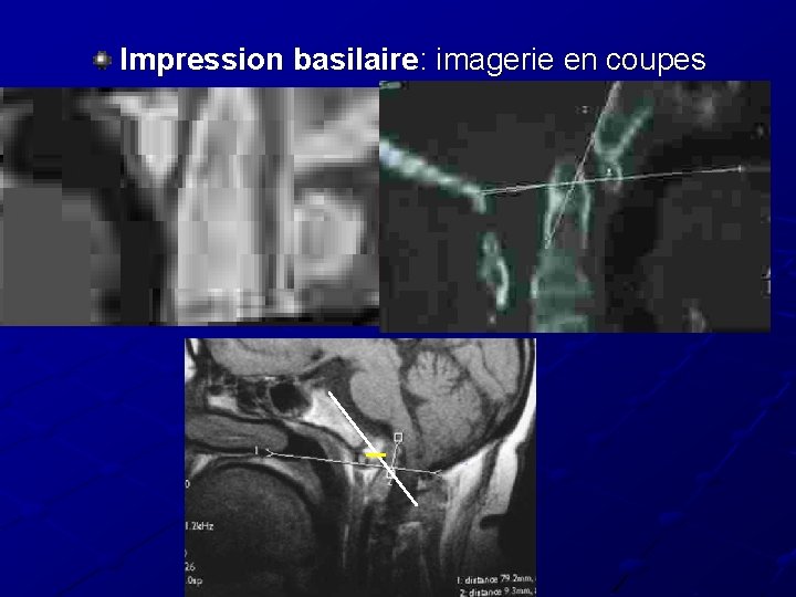 Impression basilaire: imagerie en coupes Impression basilaire: imagerie en coupes