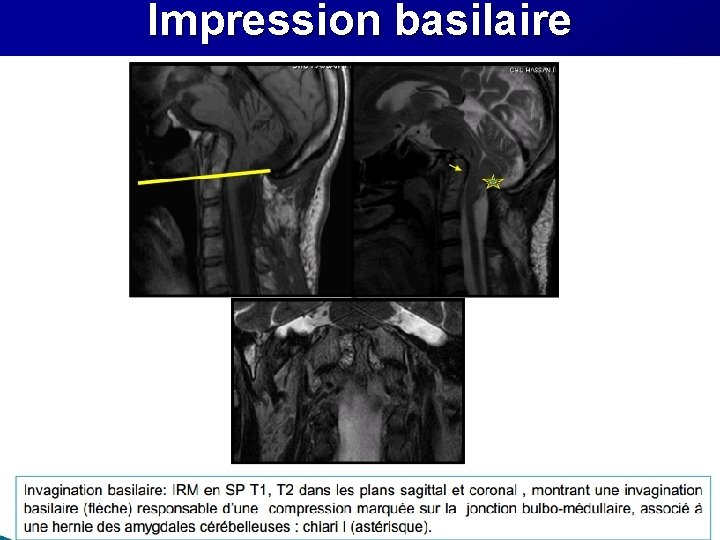 Impression basilaire Impression basilaire