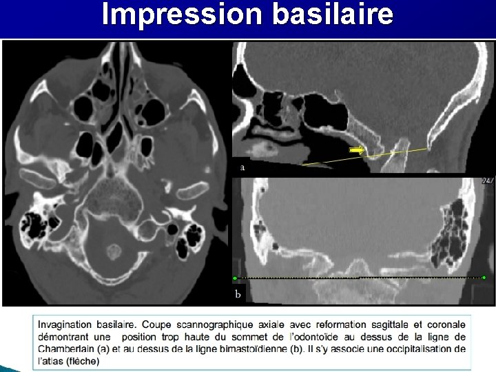 Impression basilaire Impression basilaire