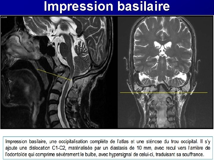 Impression basilaire Impression basilaire