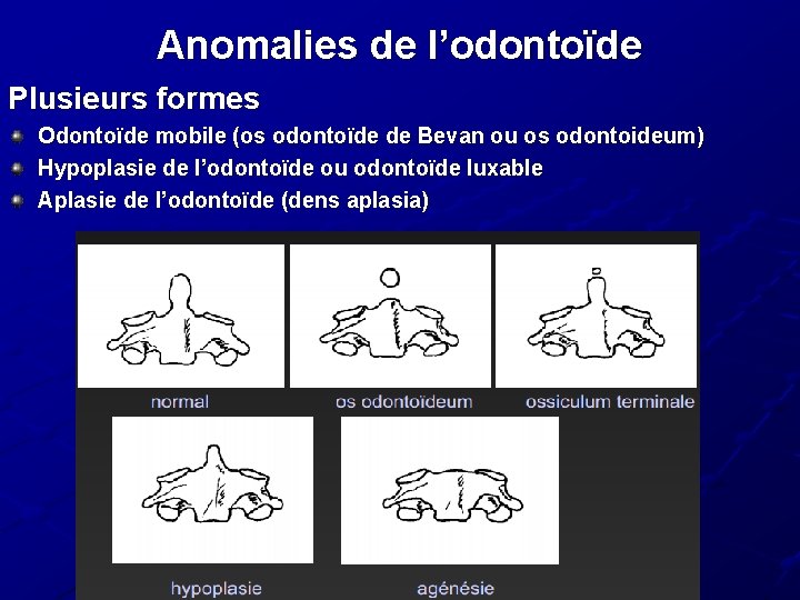 Anomalies de l’odontoïde Plusieurs formes Odontoïde mobile (os odontoïde de Bevan ou os odontoideum) Anomalies de l’odontoïde Plusieurs formes Odontoïde mobile (os odontoïde de Bevan ou os odontoideum)