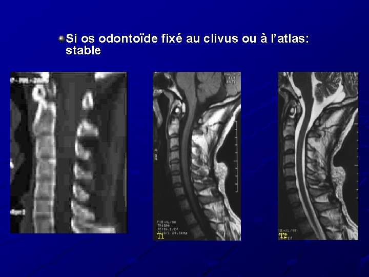 Si os odontoïde fixé au clivus ou à l’atlas: stable Si os odontoïde fixé au clivus ou à l’atlas: stable