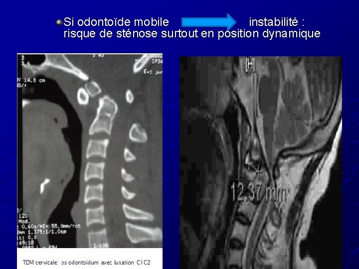 Si odontoïde mobile instabilité : risque de sténose surtout en position dynamique Si odontoïde mobile instabilité : risque de sténose surtout en position dynamique