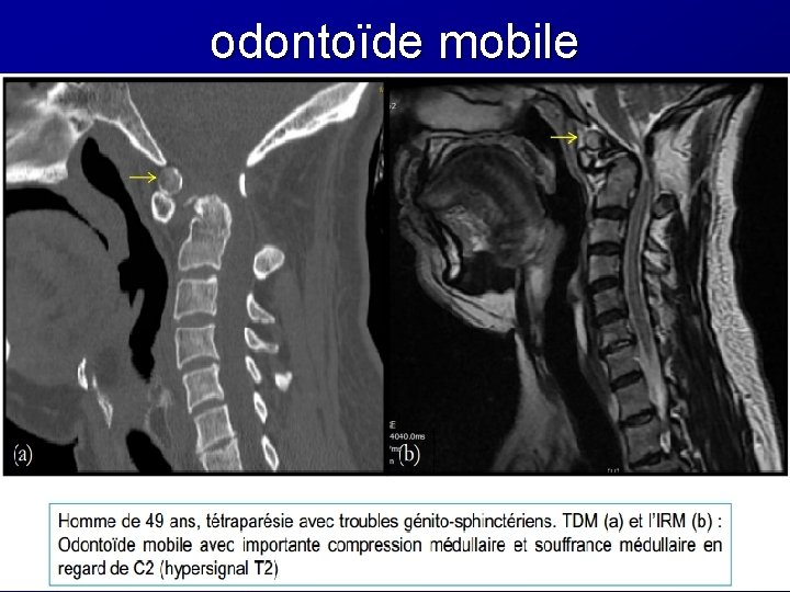odontoïde mobile odontoïde mobile