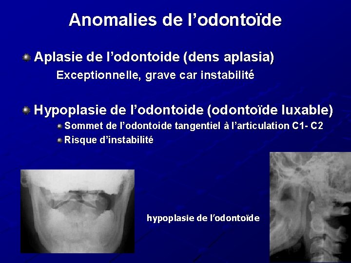Anomalies de l’odontoïde Aplasie de l’odontoide (dens aplasia) Exceptionnelle, grave car instabilité Hypoplasie de