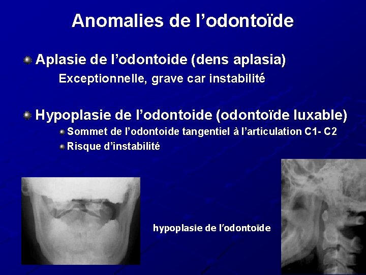 Anomalies de l’odontoïde Aplasie de l’odontoide (dens aplasia) Exceptionnelle, grave car instabilité Hypoplasie de Anomalies de l’odontoïde Aplasie de l’odontoide (dens aplasia) Exceptionnelle, grave car instabilité Hypoplasie de