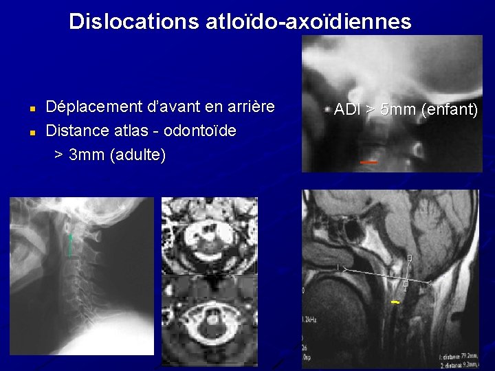 Dislocations atloïdo-axoïdiennes n n Déplacement d’avant en arrière Distance atlas - odontoïde > 3