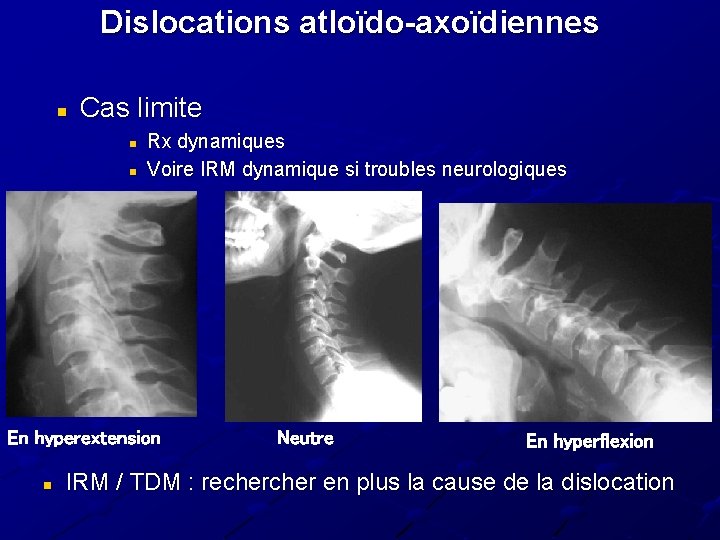 Dislocations atloïdo-axoïdiennes n Cas limite n n Rx dynamiques Voire IRM dynamique si troubles Dislocations atloïdo-axoïdiennes n Cas limite n n Rx dynamiques Voire IRM dynamique si troubles