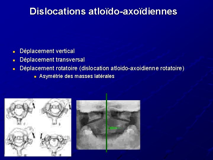 Dislocations atloïdo-axoïdiennes n n n Déplacement vertical Déplacement transversal Déplacement rotatoire (dislocation atloido-axoidienne rotatoire) Dislocations atloïdo-axoïdiennes n n n Déplacement vertical Déplacement transversal Déplacement rotatoire (dislocation atloido-axoidienne rotatoire)