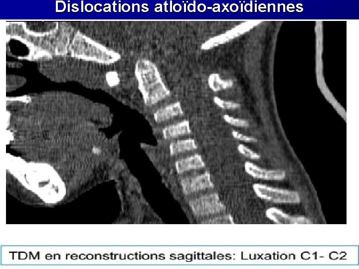 Dislocations atloïdo-axoïdiennes Dislocations atloïdo-axoïdiennes