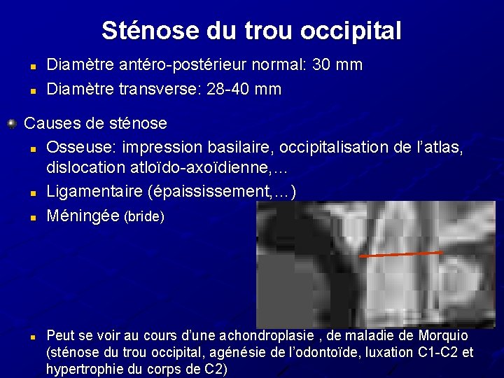 Sténose du trou occipital n n Diamètre antéro-postérieur normal: 30 mm Diamètre transverse: 28