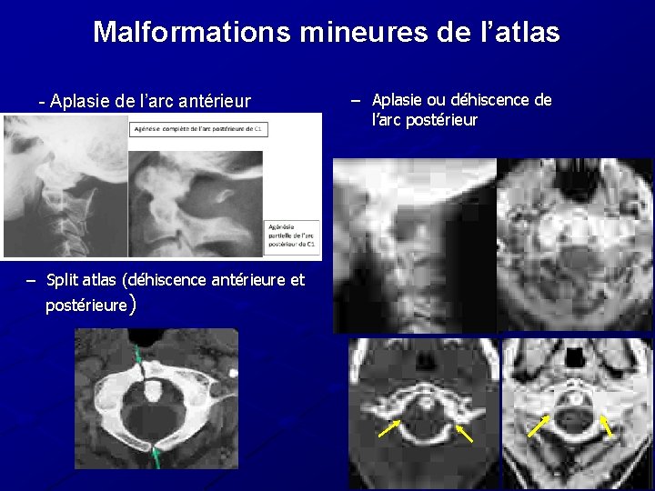 Malformations mineures de l’atlas - Aplasie de l’arc antérieur – Split atlas (déhiscence antérieure Malformations mineures de l’atlas - Aplasie de l’arc antérieur – Split atlas (déhiscence antérieure