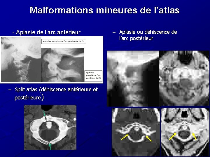 Malformations mineures de l’atlas - Aplasie de l’arc antérieur – Split atlas (déhiscence antérieure