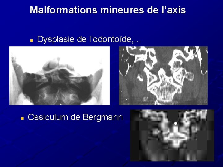 Malformations mineures de l’axis n n Dysplasie de l’odontoïde, … Ossiculum de Bergmann Malformations mineures de l’axis n n Dysplasie de l’odontoïde, … Ossiculum de Bergmann
