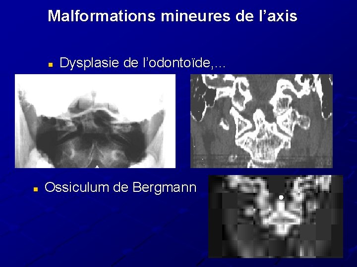 Malformations mineures de l’axis n n Dysplasie de l’odontoïde, … Ossiculum de Bergmann 