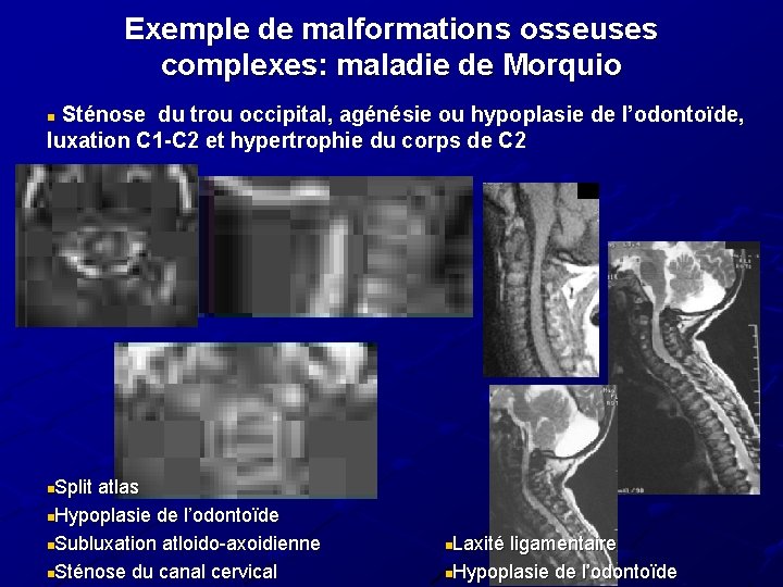 Exemple de malformations osseuses complexes: maladie de Morquio Sténose du trou occipital, agénésie ou