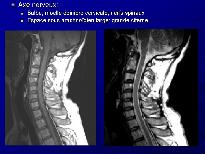Axe nerveux: n n Bulbe, moelle épinière cervicale, nerfs spinaux Espace sous arachnoïdien large: Axe nerveux: n n Bulbe, moelle épinière cervicale, nerfs spinaux Espace sous arachnoïdien large: