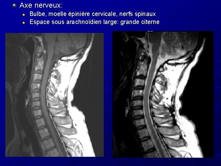 Axe nerveux: n n Bulbe, moelle épinière cervicale, nerfs spinaux Espace sous arachnoïdien large: