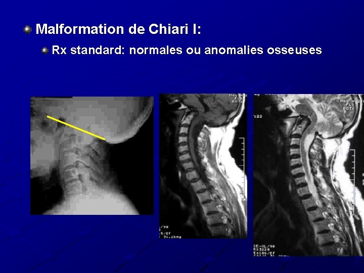 Malformation de Chiari I: Rx standard: normales ou anomalies osseuses 