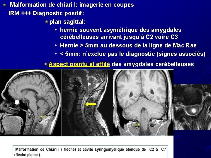 Malformation de chiari I: imagerie en coupes IRM +++ Diagnostic positif: plan sagittal: • Malformation de chiari I: imagerie en coupes IRM +++ Diagnostic positif: plan sagittal: •