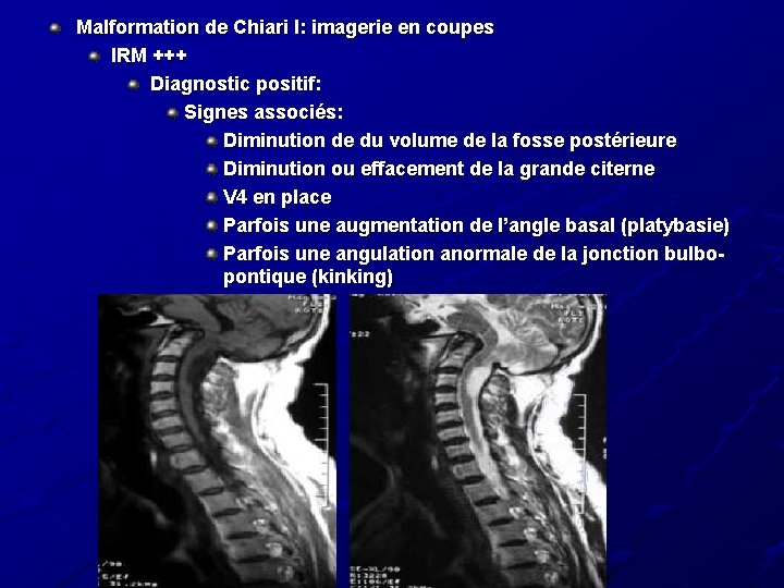 Malformation de Chiari I: imagerie en coupes IRM +++ Diagnostic positif: Signes associés: Diminution Malformation de Chiari I: imagerie en coupes IRM +++ Diagnostic positif: Signes associés: Diminution