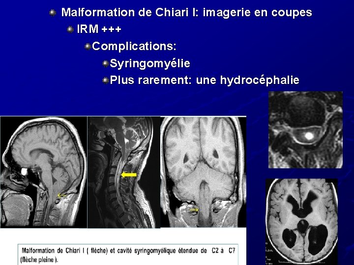 Malformation de Chiari I: imagerie en coupes IRM +++ Complications: Syringomyélie Plus rarement: une Malformation de Chiari I: imagerie en coupes IRM +++ Complications: Syringomyélie Plus rarement: une