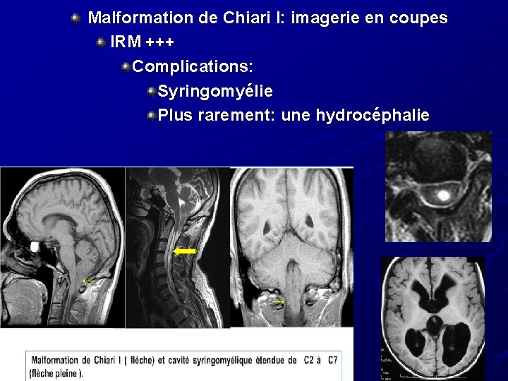 Malformation de Chiari I: imagerie en coupes IRM +++ Complications: Syringomyélie Plus rarement: une