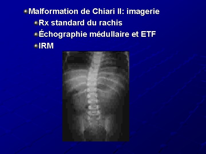 Malformation de Chiari II: imagerie Rx standard du rachis Échographie médullaire et ETF IRM