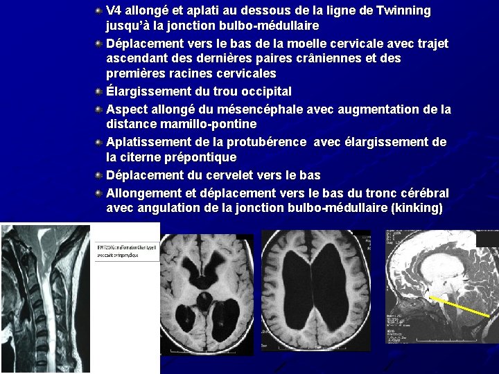 V 4 allongé et aplati au dessous de la ligne de Twinning jusqu’à la