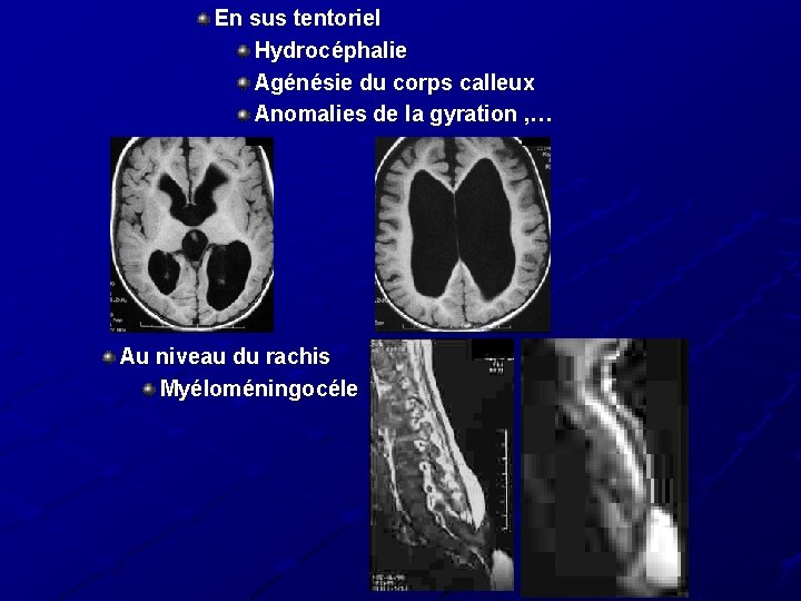 En sus tentoriel Hydrocéphalie Agénésie du corps calleux Anomalies de la gyration , …