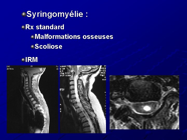 Syringomyélie : Rx standard Malformations osseuses Scoliose IRM Syringomyélie : Rx standard Malformations osseuses Scoliose IRM