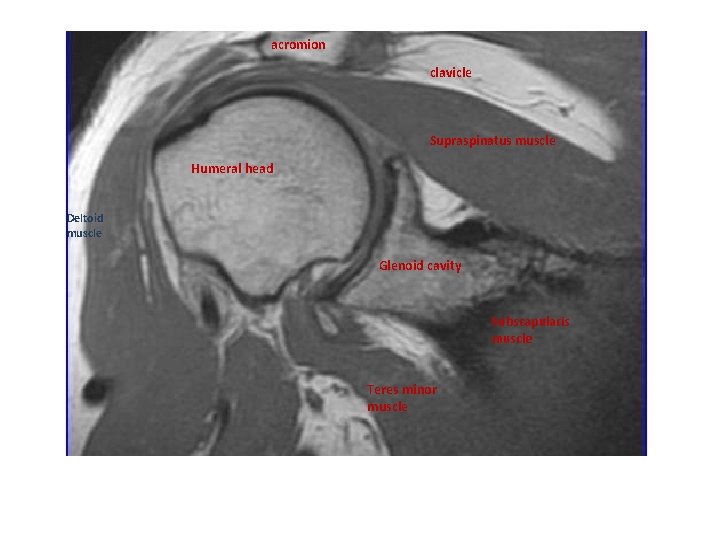 acromion clavicle Supraspinatus muscle Humeral head Deltoid muscle Glenoid cavity Subscapularis muscle Teres minor