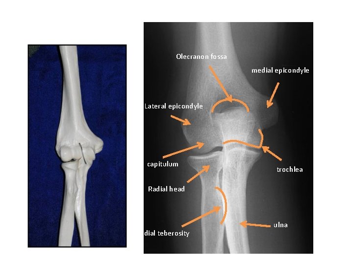 Olecranon fossa medial epicondyle Lateral epicondyle capitulum trochlea Radial head Radial teberosity ulna 