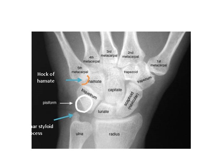 Hock of hamate Ulnar styloid process 
