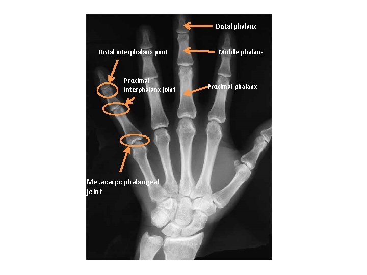 Distal phalanx Distal interphalanx joint Proximal interphalanx joint Metacarpophalangeal joint Middle phalanx Proximal phalanx