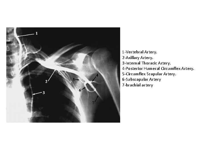 1 -Vertebral Artery. 2 -Axillary Artery. 3 -Internal Thoracic Artery. 4 -Posterior Humeral Circumflex